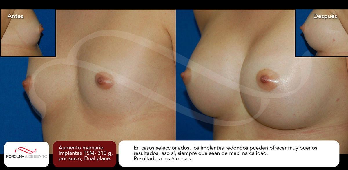 Aumento mamario. Implantes TSM-310 g, por surco, Dual plane